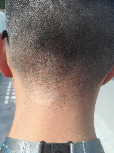 后脑勺这里有几块白斑,一两年前就有了 只有黄豆大小,本人男现在变