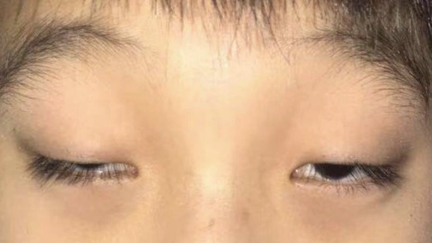 先天性上睑下垂 由于动眼神经核或提上睑肌发育不全所致,其中肌源性