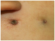 什么是钙化上皮瘤(毛母质瘤),孩子长了钙化上皮瘤如何处理