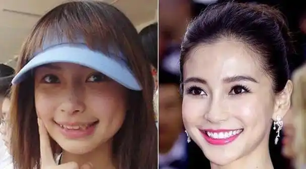 整牙让某些明星有了显著的美容效果,整牙后,他们的牙齿排列更加整齐