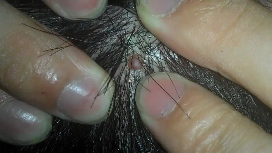 问:我头皮上涨了一个这样的软软的肉包 ,好几年了,也没长大, 不痛不痒