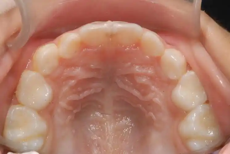 乳牙列的上颌:10颗牙恒牙列的上颌:14颗牙(除外智齿)而拔牙矫治后剩余