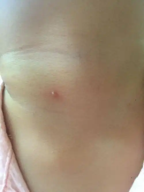 鳃瘘会因为温度的不同而有变化吗,一周九的孩子脖子上有很小的水泡