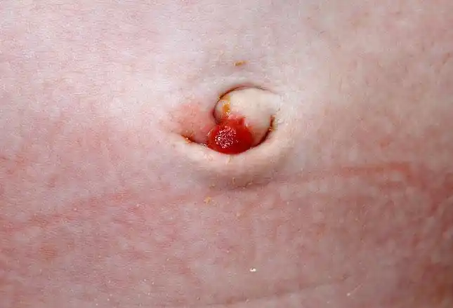 急腹症的相关内容,今日继续,详情如下: 第八题: 脐部肉芽肿(如上图示