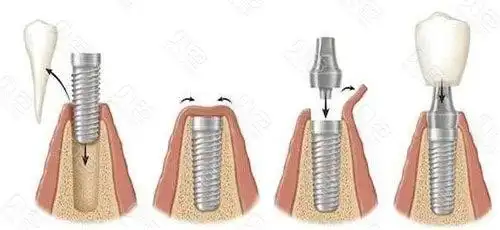 种植牙示意图