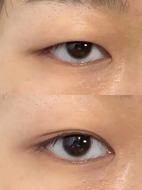 单眼皮肿眼泡双眼皮贴详细教程