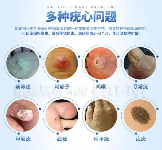 x瘊疣平疣净鸡眼脚刺垫老茧肉刺扁去疣液膏cy_去疣净专卖店专柜商城