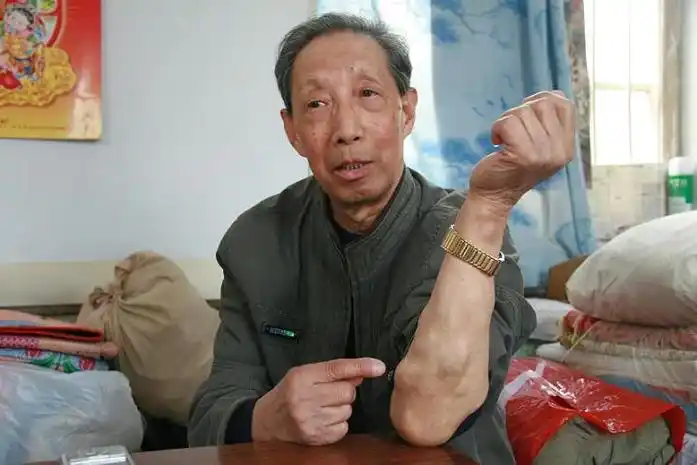 皮下脂肪瘤图片46