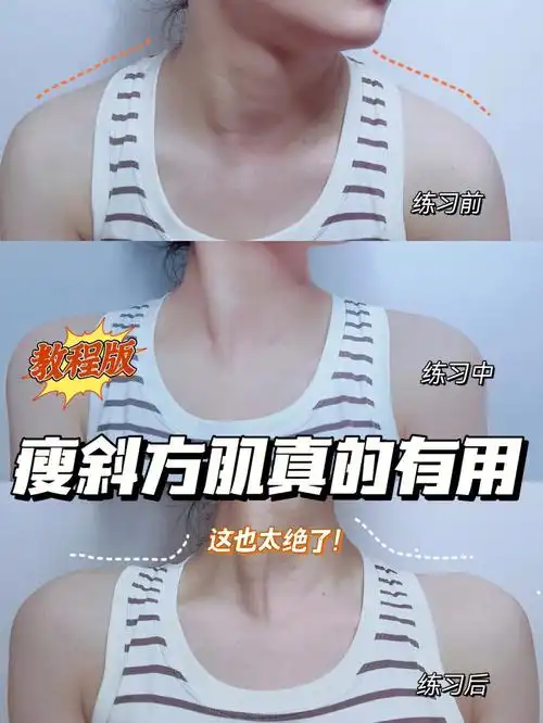 斜方肌,不仅人精神了,体态也能更好了#直角肩  #斜方肌  #消除斜方肌