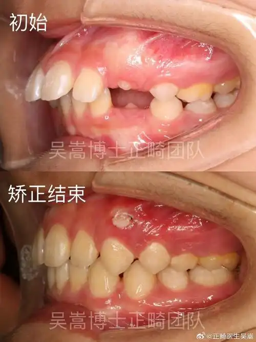 龅牙##下巴后缩##牙齿矫正##南京牙齿矫正