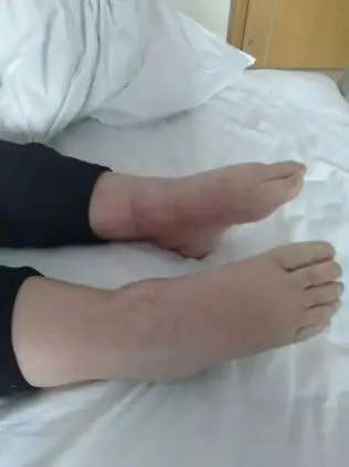 19岁少女双下肢肾病性水肿难消除 祈康肾内一科帮其排"肿"解难!