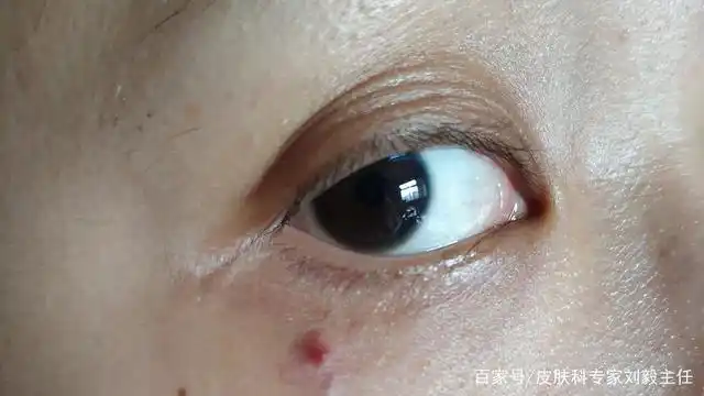 皮肤上的痣该如何区分?该如何应对?激光祛除还是手术去除好?