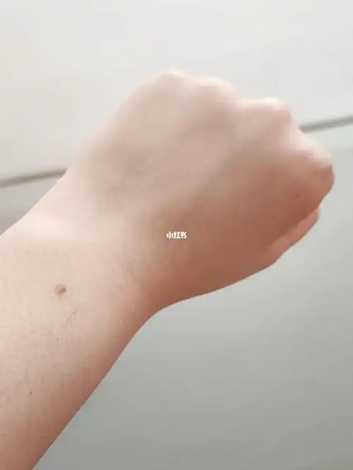 看到好多人都左手有痣