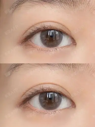 做完平扇双眼皮5个月了,还算成功吗