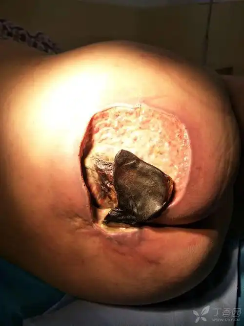 烫伤后皮肤坏死感染 [病例帖]