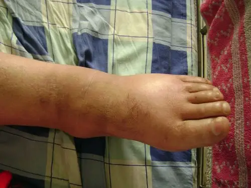 大家谁见过橡皮腿丝虫病这个像不像我没见过