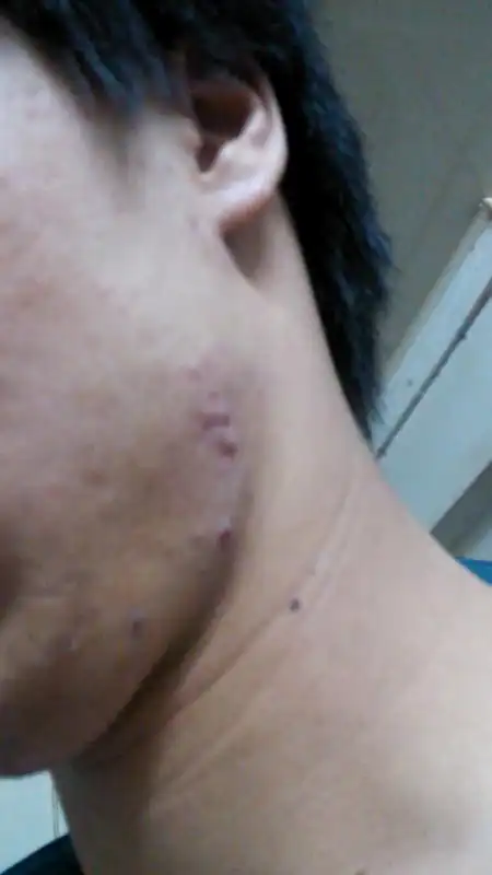 脖子长了肉疙瘩,有差不多两年了,无法好啊