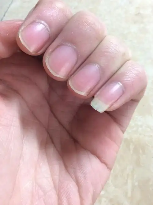 这样指甲正常吗,是不是缺什么,是不是天气冷冻的啊,我一到冬天手脚