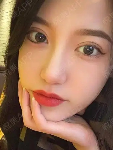 1w做的8mm全切双眼皮子绝了