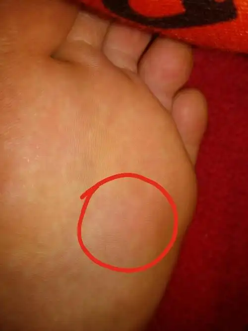 脚底有块地方痛,怎么回事,现在按压还不痛,就是穿鞋搁到了才痛.麻