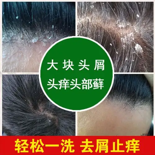 屑康王去屑止痒洗发水去大块头皮屑神器去头屑头痒头皮藓除头蟎虫