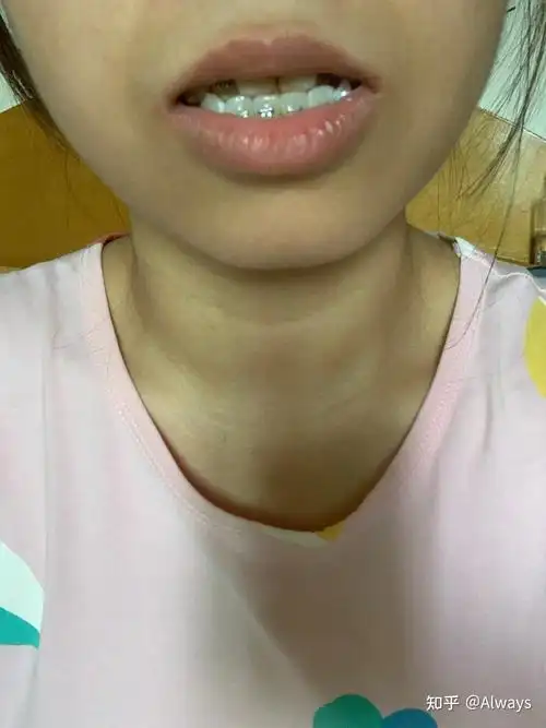 虎牙矫正 - 知乎