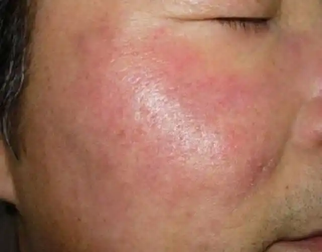 皮肤瘙痒灼热该怎么办?教你改善敏感肌瘙痒问题! - 知乎