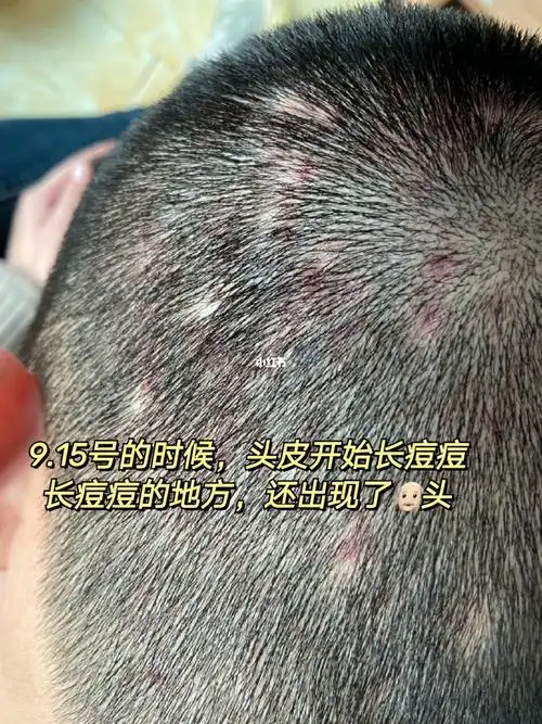 图16615-36615是我去年10月份的时候,头皮长毛囊炎痘痘的情况