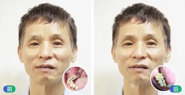 退休老人种植牙术前术后对比(组图)_广州曙光美容牙科医院_国内整形第