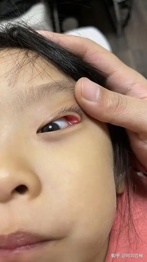 孩子眼皮长了个小包 - 知乎