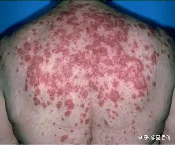 亚急性皮肤型红斑狼疮