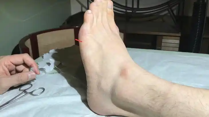 脚掌股的前缘,靠近缘心端的下方,有个凹陷处,你可以摸到这边有个骨头