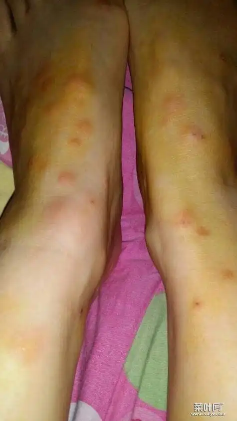 皮肤里面有硬疙瘩会痒 艾滋病疙瘩真实图片