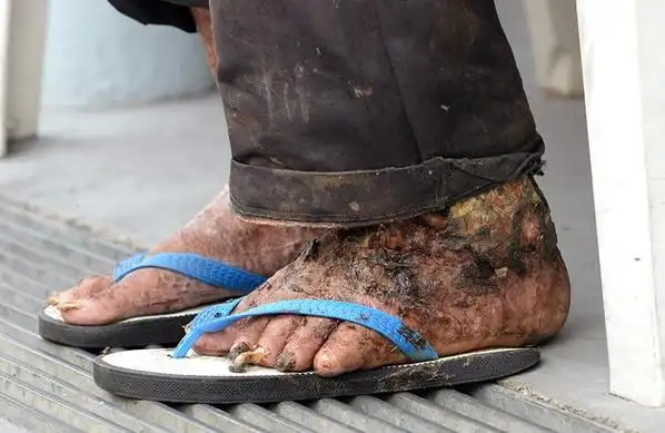 脚烂长蛆虫发臭br老汉担心截肢拒治疗