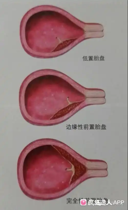 胎盘后壁宫底什么意思是不是特低啊,急