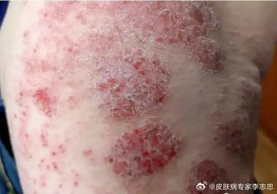 皮肤病#马齿苋在皮肤科的应用一览表!