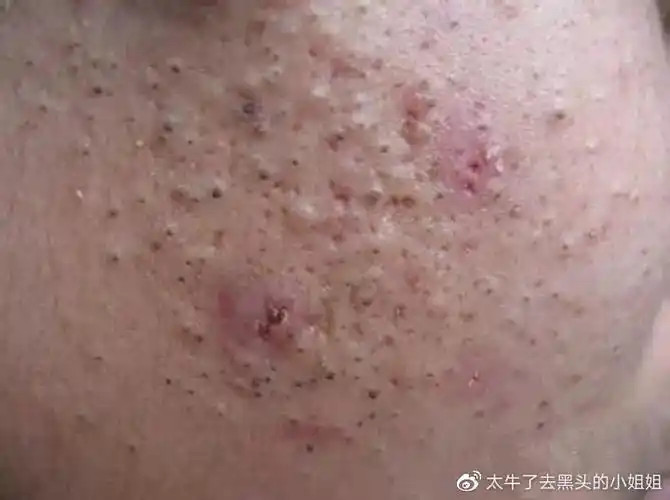 可见的油脂角栓堵塞毛孔,这种是非常严重的了