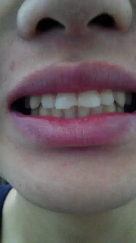 这样的牙齿咬合正常吗