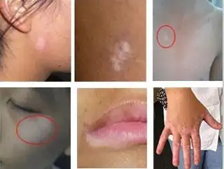 白斑初期症状图片与治疗