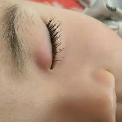 孩子眼皮上长了一个小疙瘩都已经挺长时间了,但是最近发现有点红,宝宝