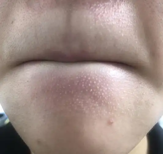 【反馈】去闭口利器啊!敏感皮慎用!新增.