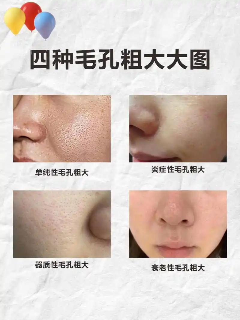 毛孔粗大应该怎么办#毛孔粗大 #抖音图文来了 @dou 小助 - 抖音