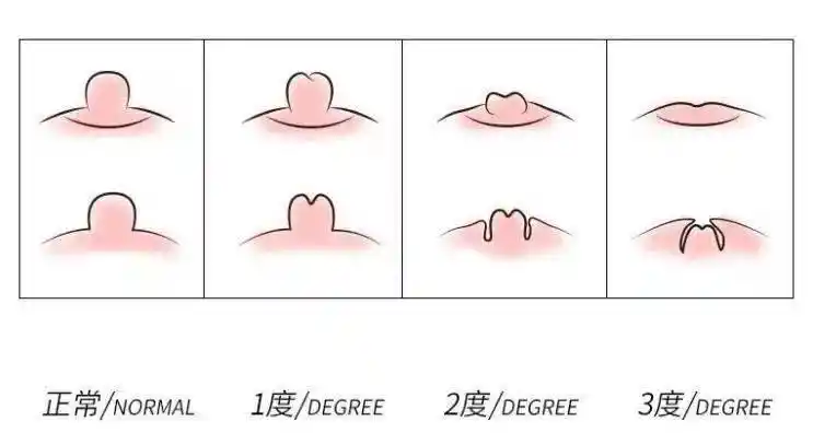 乳头内陷的护理方法1,轻度乳头内陷护理方法:对于正值青春发育期的