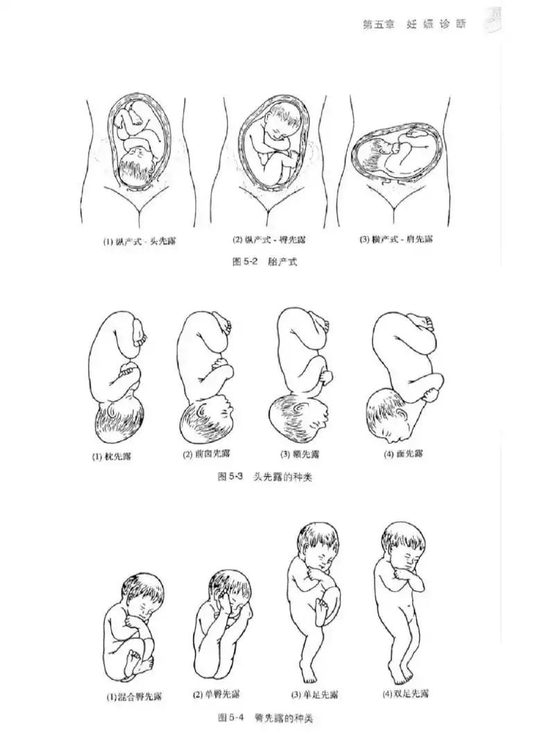 胎儿的头位一般分为三类:头位,臀位,横位 头位: 胎儿头部朝下,可死