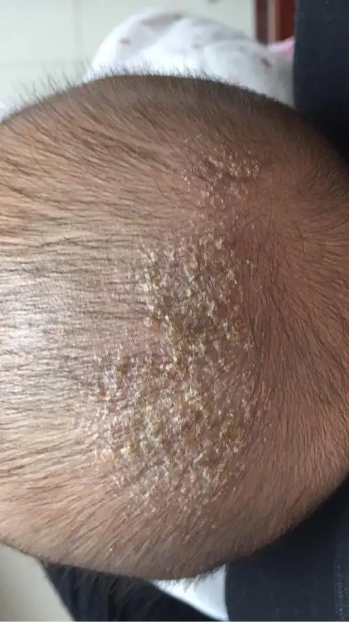 宝宝头皮干,说是脂溢性湿疹求好方法去看了医生给拿一个糠酸莫米膏