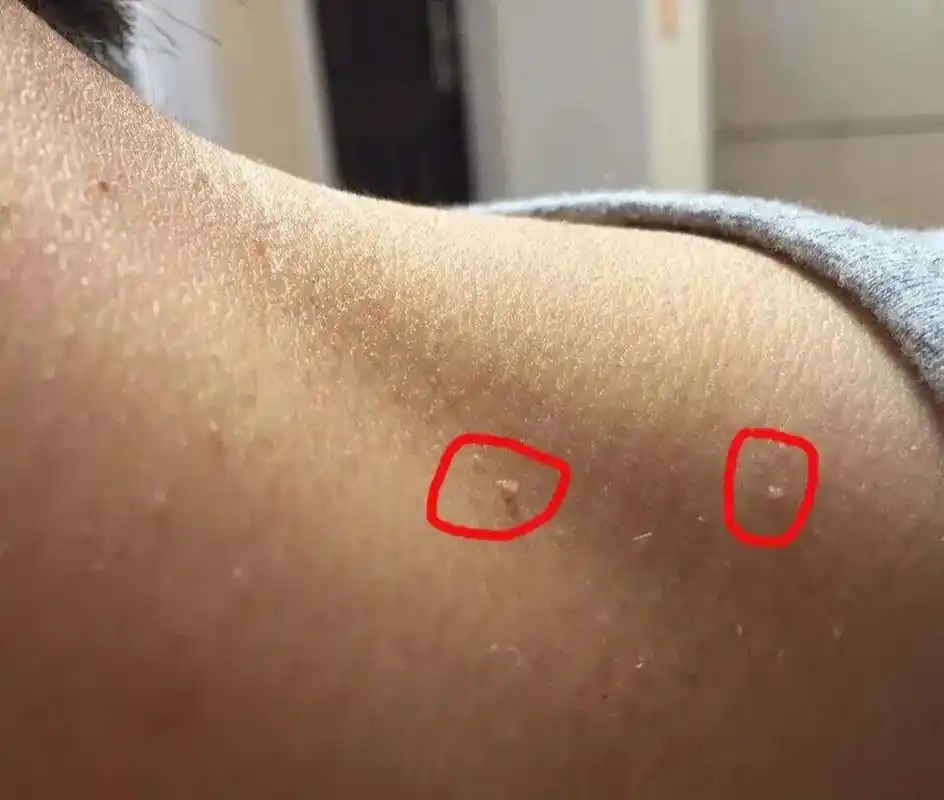 软纤维瘤(皮赘)如何处理 很多人都有像以下图片这样的情况,就是脖子