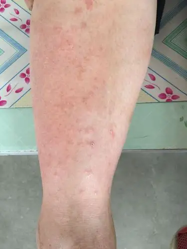 特别痒 胳膊上也有 昨天吃了虾 但之前也没有反应啊 这是过敏吗