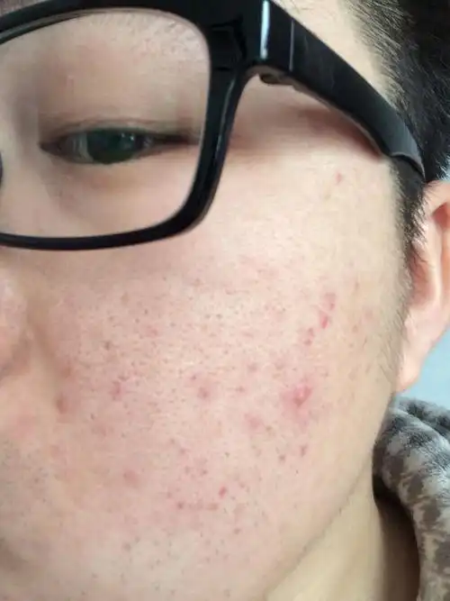 我是男生,毛孔粗大好几年了,真的很烦恼,在网上查的资料还乱七八糟