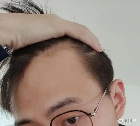 20多岁的男生有一个m型发际线是怎样的体验