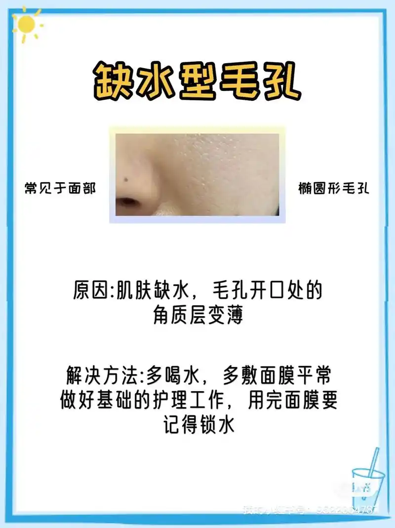 四种毛孔粗大类型你是哪一种正确护肤